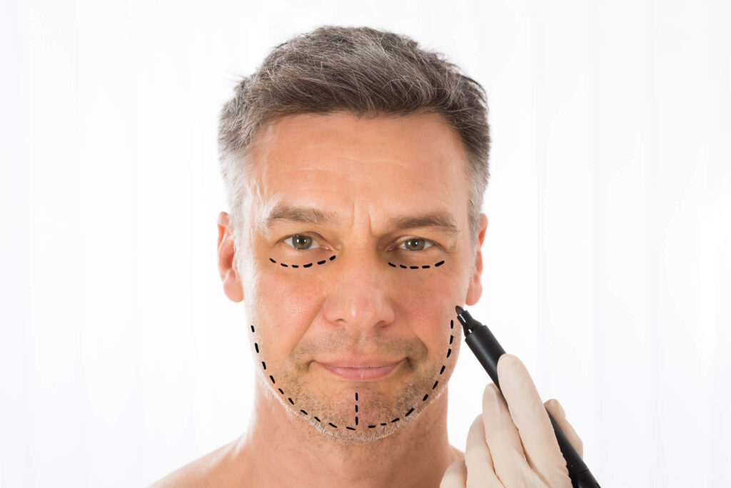 A middle-aged man with pre-operative facelift markings drawn on his face and jawline ahead of facelift surgery in Bangkok, Thailand.