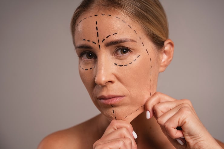 A woman with comprehensive pre-operative facelift markings covering the forehead, cheeks, jawline, and neck ahead of facial rejuvenation surgery in Thailand.