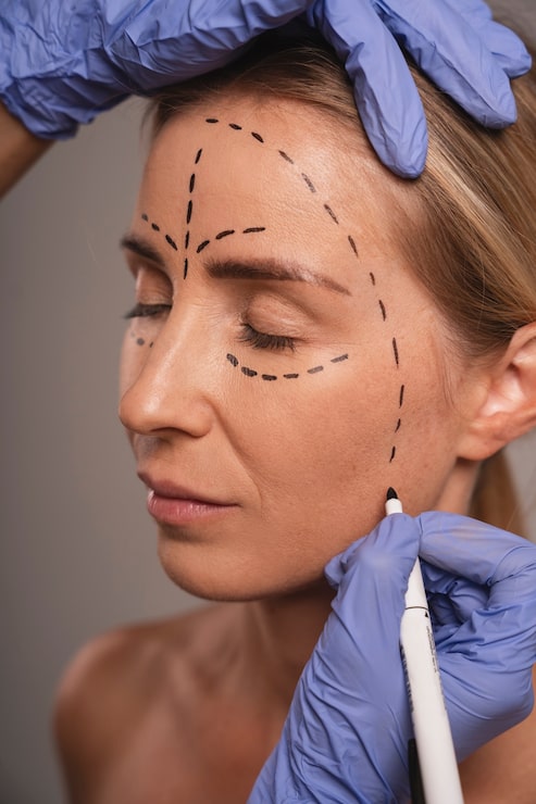 A surgeon in blue latex gloves drawing detailed pre-operative markings on a female patient's face before facelift surgery in Bangkok, Thailand.