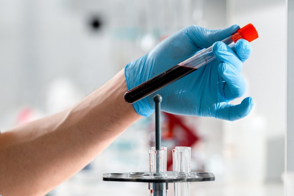 Lab technician handling blood sample vial for health screening test for Bangkok health check-up